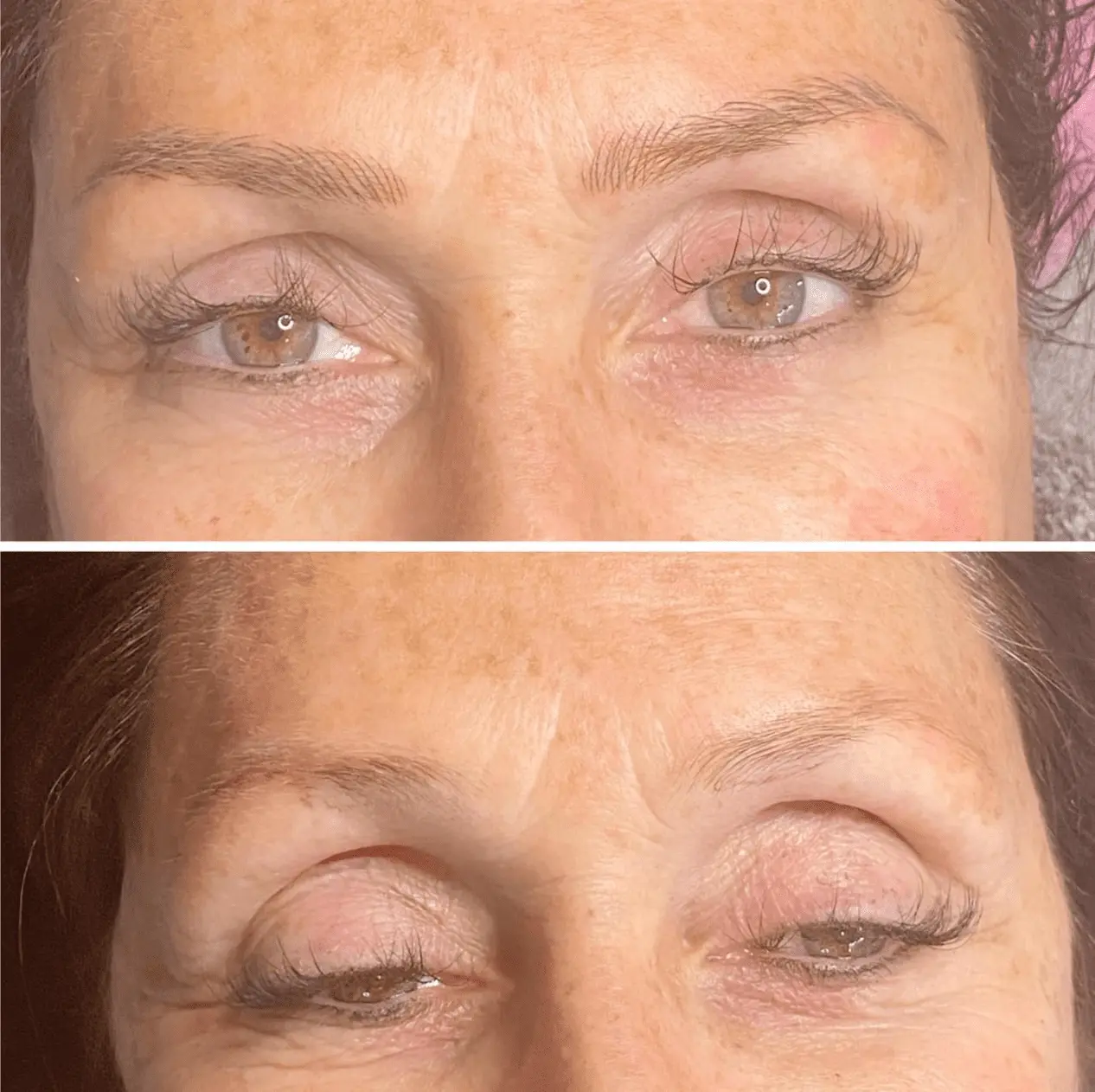 Saline Microblading Removal Before And After